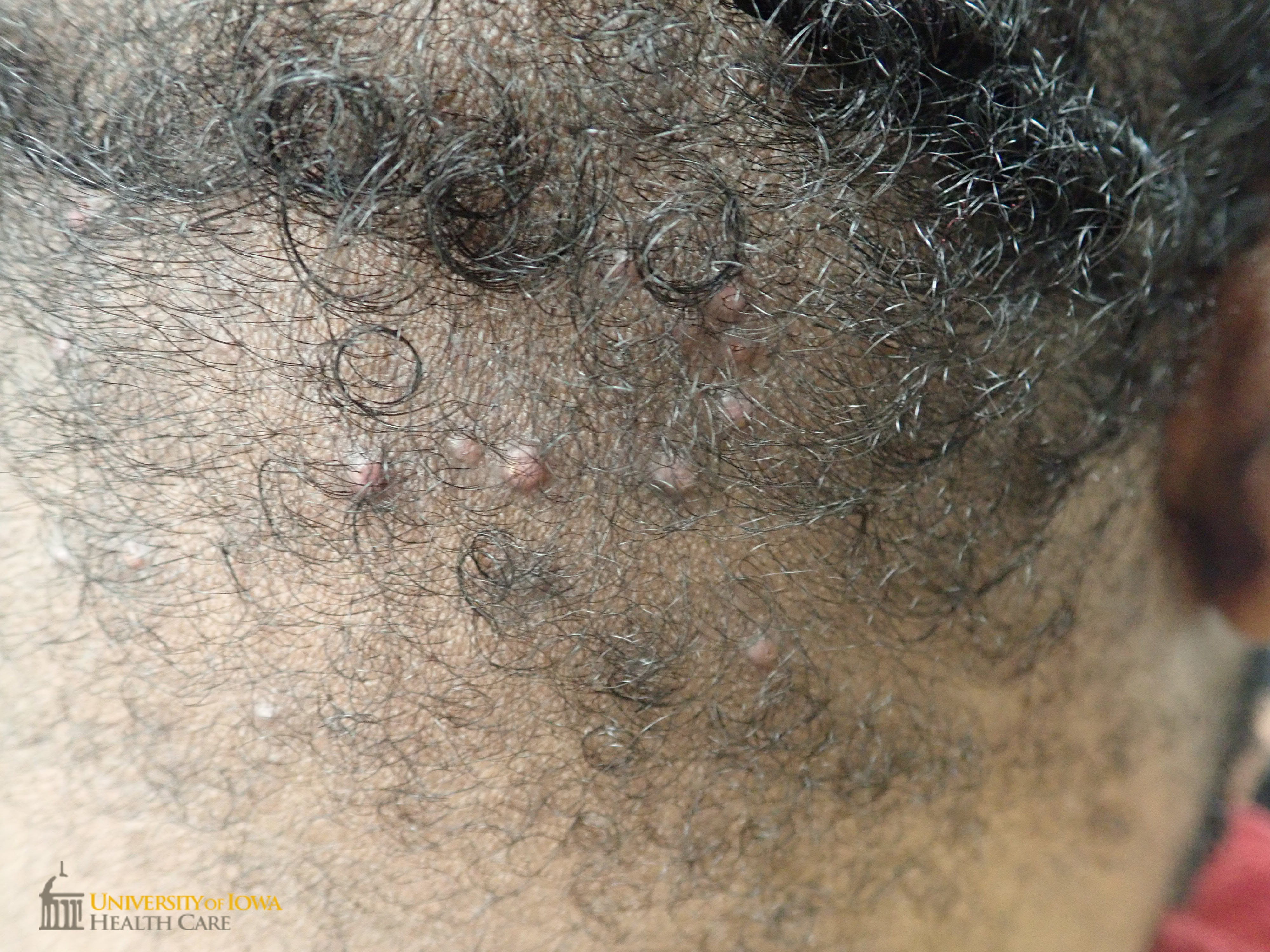 Grouped pink keloidal papules on the occipital scalp. (click images for higher resolution).